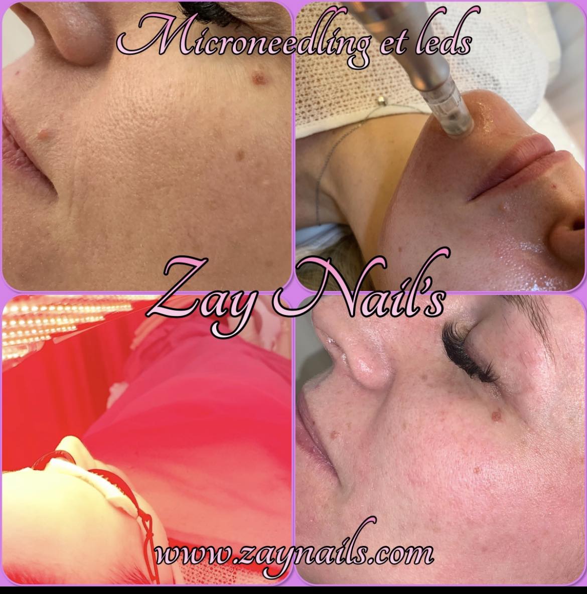 microneedling,microneedling la louvière,rajeunissement de la peau,soin visage,lalouvière,institut de beauté la louvière,resserrer les pores,masque de grossesse,atténuer les rides, ridules,cicatrices,vergetures