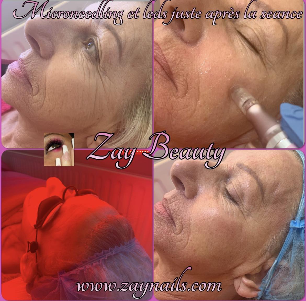 microneedling,microneedling la louvière,rajeunissement de la peau,soin visage,lalouvière,institut de beauté la louvière,resserrer les pores,masque de grossesse,atténuer les rides, ridules,cicatrices,vergetures